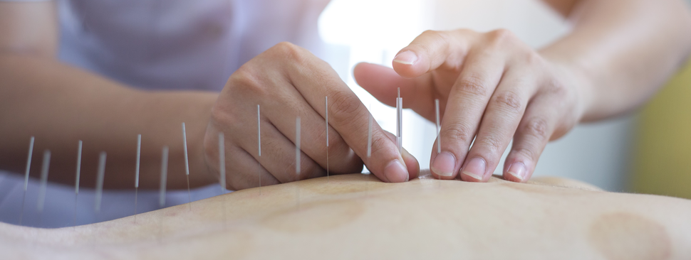 A person gets accupuncture