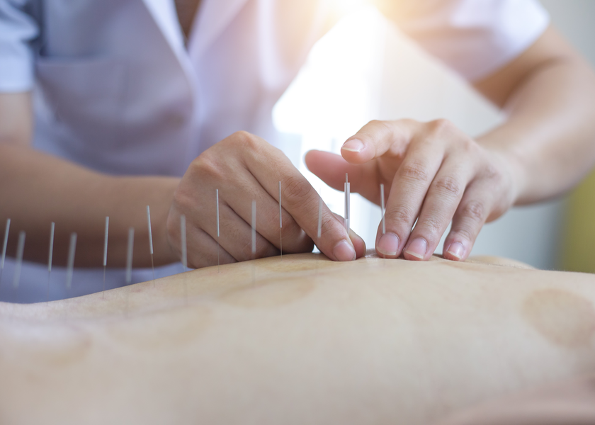 person getting accupuncture