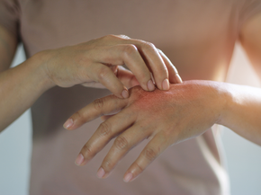 Woman with bug bite on hand