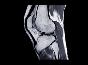 MRI of knee joint