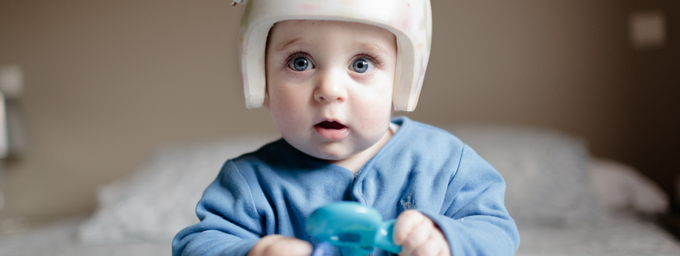 Baby wearing a helmet to correct flat head syndrome