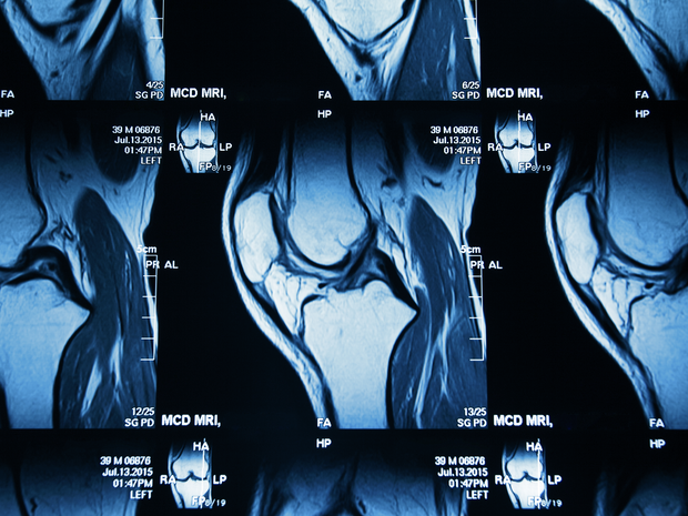 Xray image of knee joint