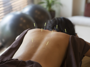 Person lying on a table receiving acupuncture