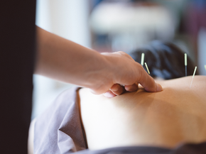Acupuncturist applying needles to patients back