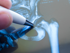 Doctor pointing to area of hip joint x-ray
