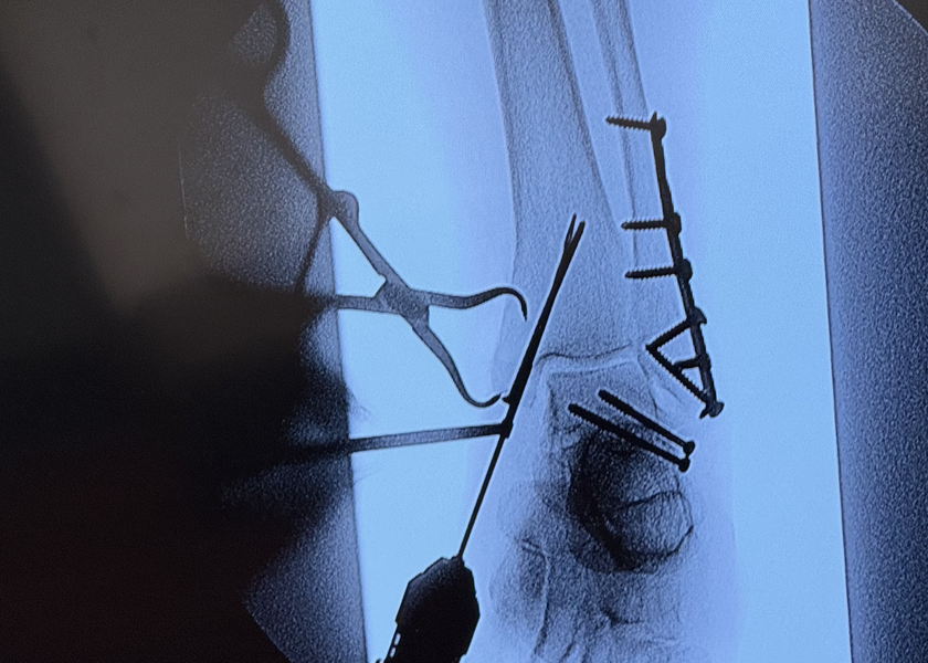 X-ray image of fractured leg