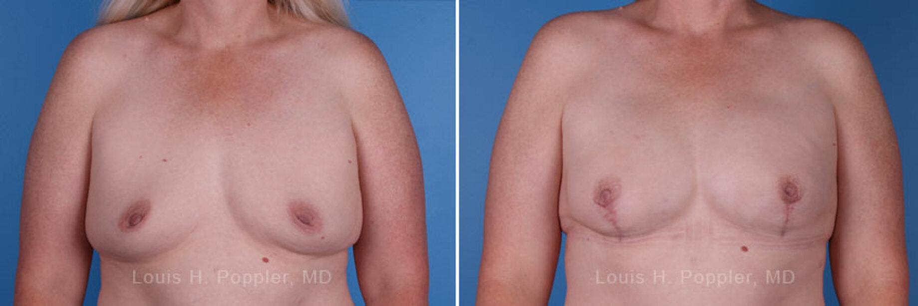Breast reconstruction surgery before and after photos