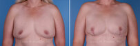 Breast reconstruction surgery before and after photos