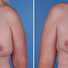 Breast reconstruction surgery before and after photos