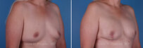 Breast reconstruction surgery before and after photos, right 45-degree angle view