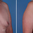 Breast reconstruction surgery before and after photos, right 45-degree angle view