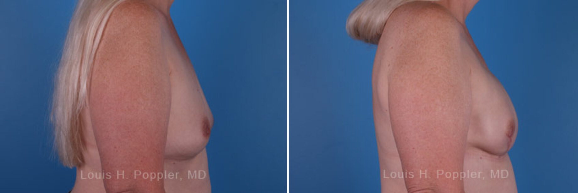 Breast reconstruction surgery before and after photos, right 90-degree angle view