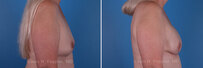Breast reconstruction surgery before and after photos, right 90-degree angle view