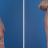 Breast reconstruction surgery before and after photos, right 90-degree angle view