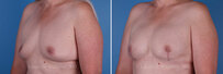 Breast reconstruction surgery before and after photos, left 45-degree angle view