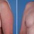 Breast reconstruction surgery before and after photos, left 45-degree angle view