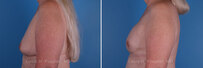 Breast reconstruction surgery before and after photos, left 90-degree angle view
