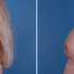 Breast reconstruction surgery before and after photos, left 90-degree angle view