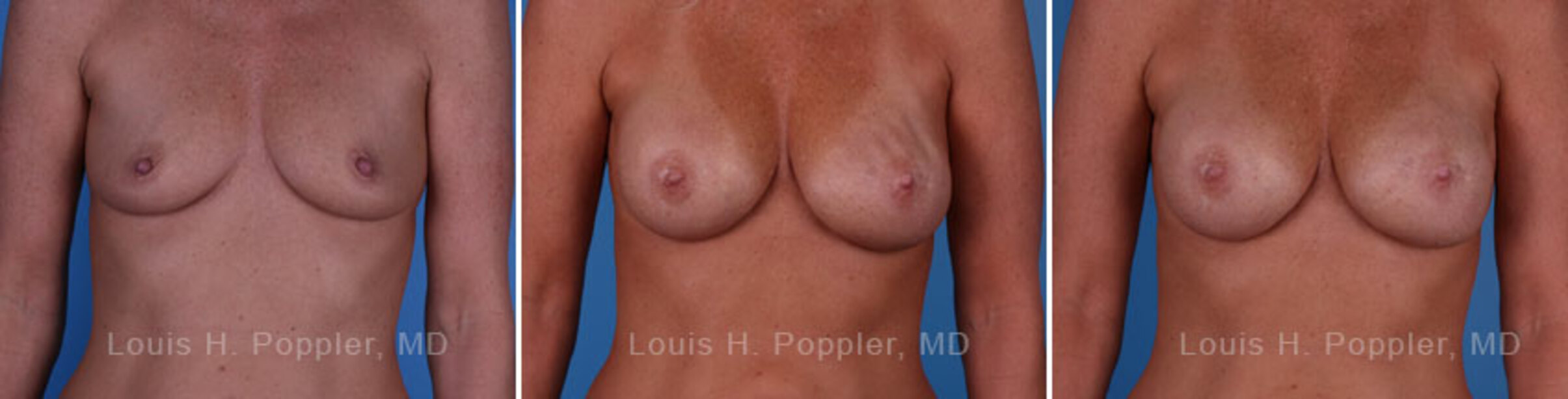 Breast reconstruction surgery before and after photos