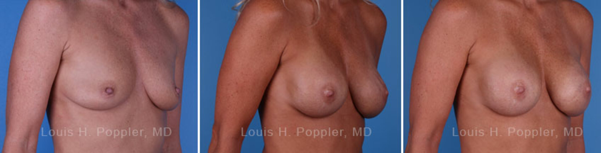 Breast reconstruction surgery before and after photos, right 45-degree angle view
