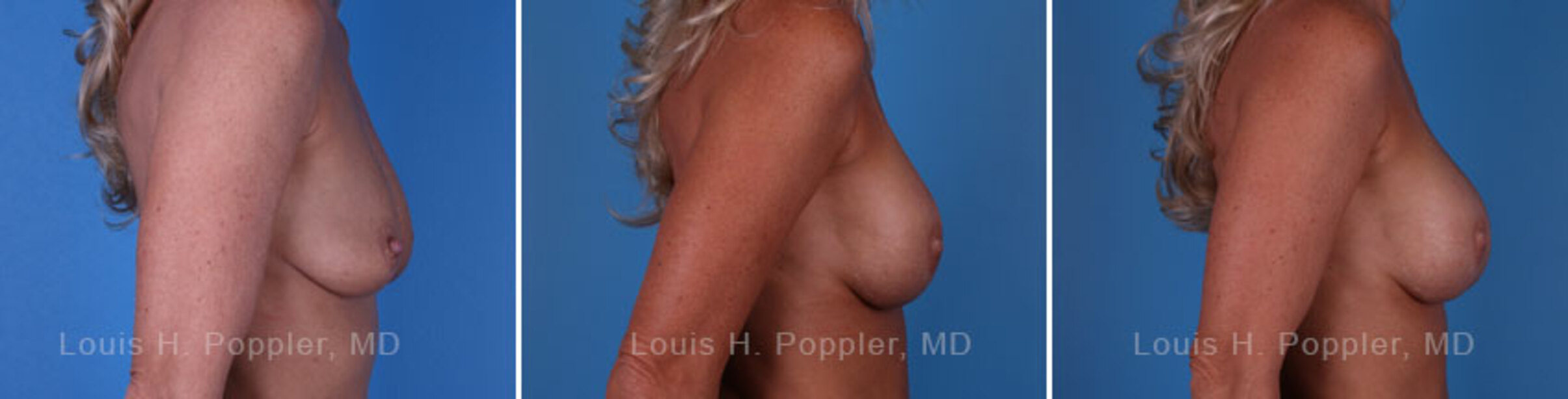 Breast reconstruction surgery before and after photos, right 90-degree angle view