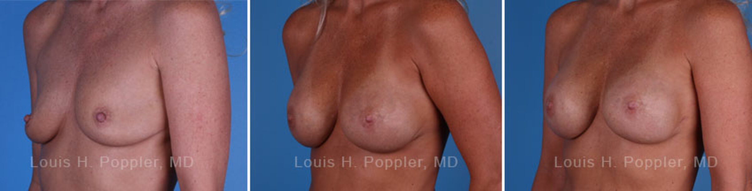 Breast reconstruction surgery before and after photos, left 45-degree angle view