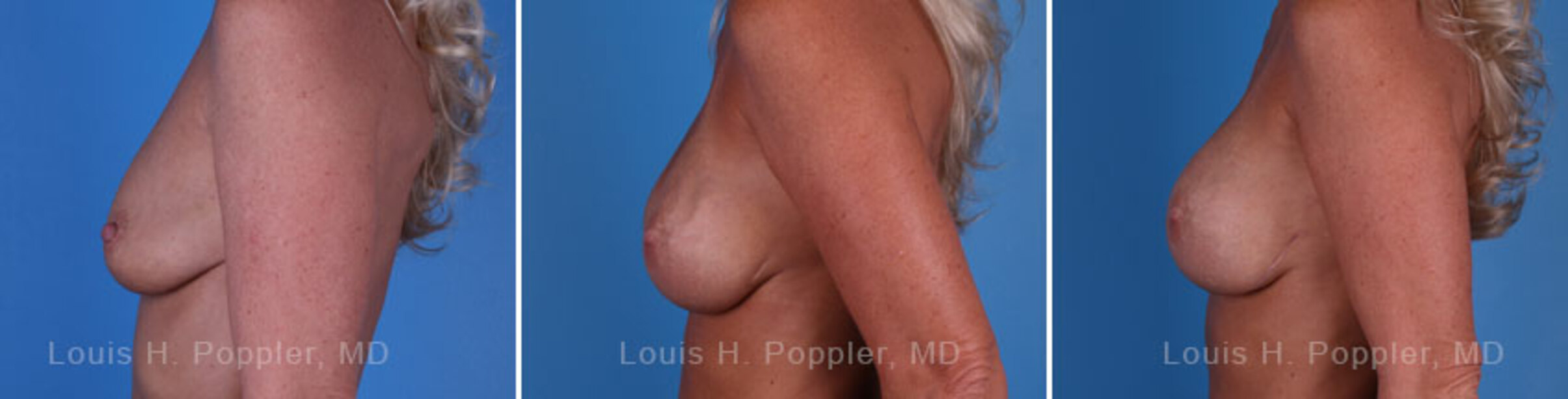 Breast reconstruction surgery before and after photos, left 90-degree angle view