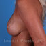 Breast reconstruction surgery before and after photos, left 90-degree angle view