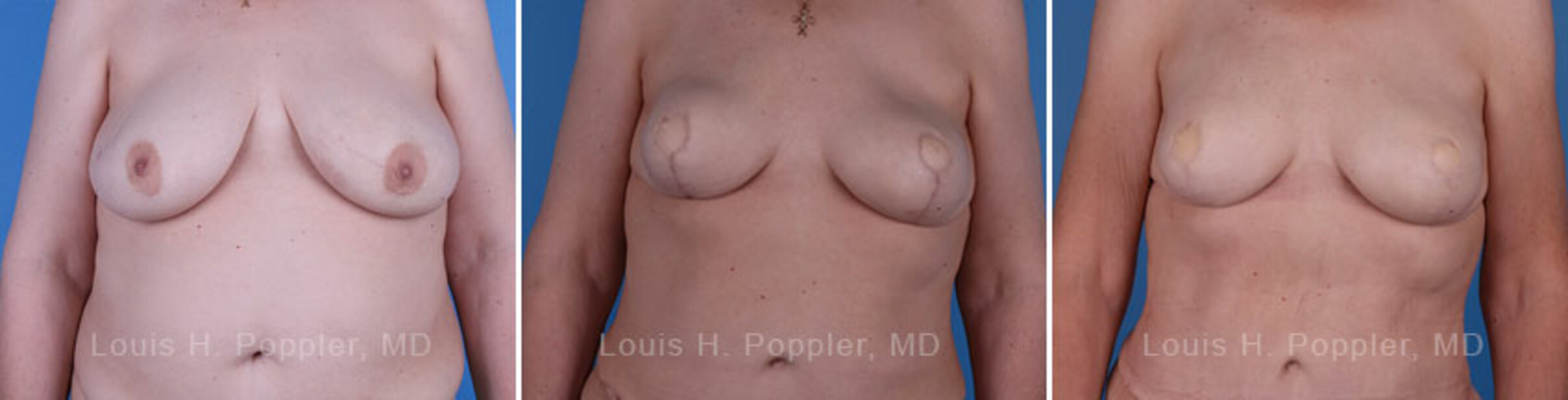 Breast reconstruction surgery before and after photos