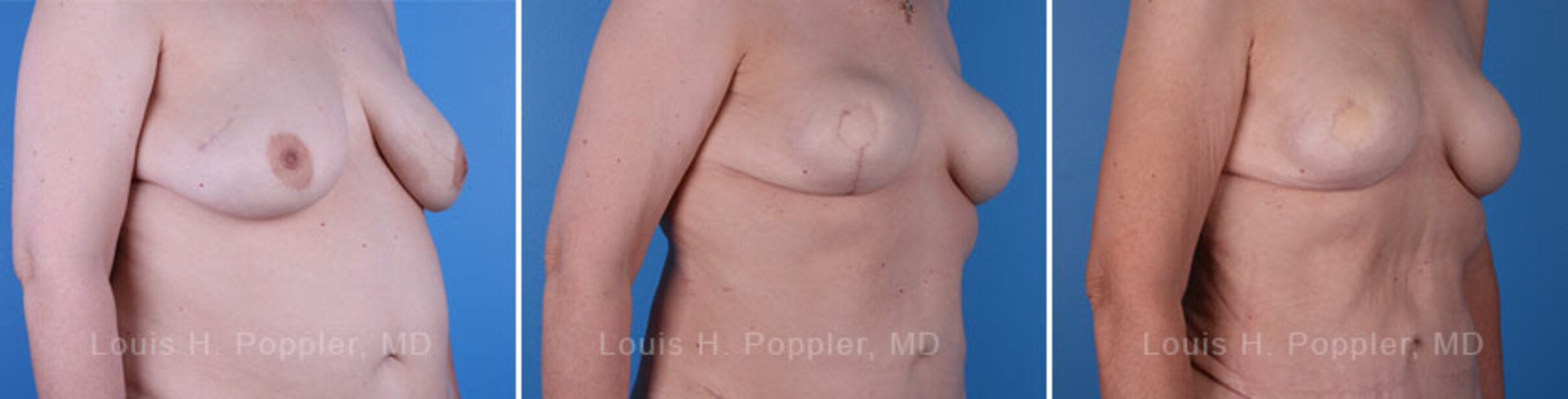 Breast reconstruction surgery before and after photos, right 45-degree angle view