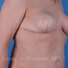Breast reconstruction surgery before and after photos, right 45-degree angle view