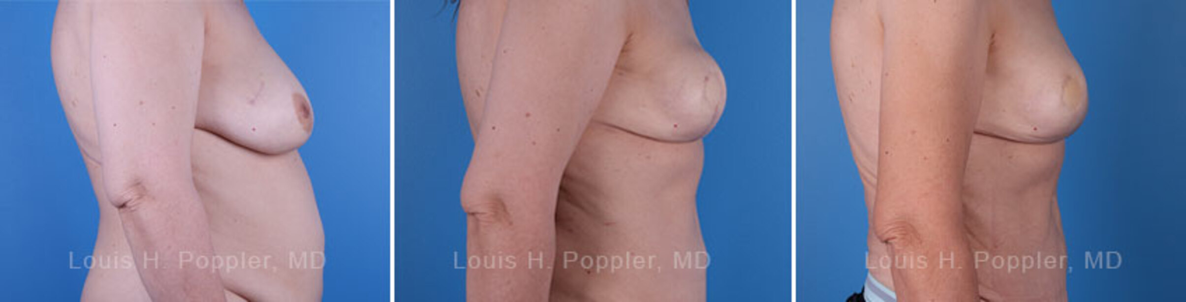 Breast reconstruction surgery before and after photos, right 90-degree angle view