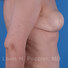Breast reconstruction surgery before and after photos, right 90-degree angle view