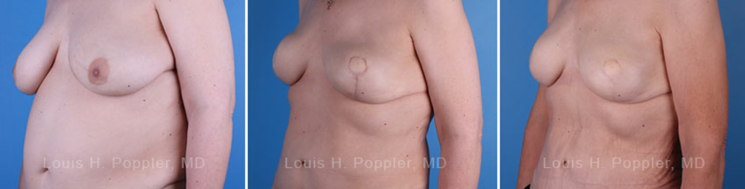 Breast reconstruction surgery before and after photos, left 45-degree angle view