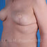 Breast reconstruction surgery before and after photos, left 45-degree angle view