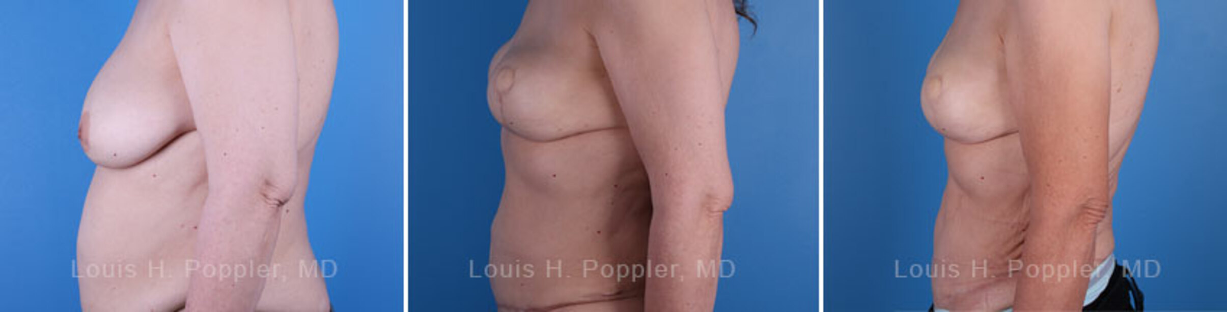 Breast reconstruction surgery before and after photos, left 90-degree angle view