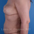 Breast reconstruction surgery before and after photos, left 90-degree angle view