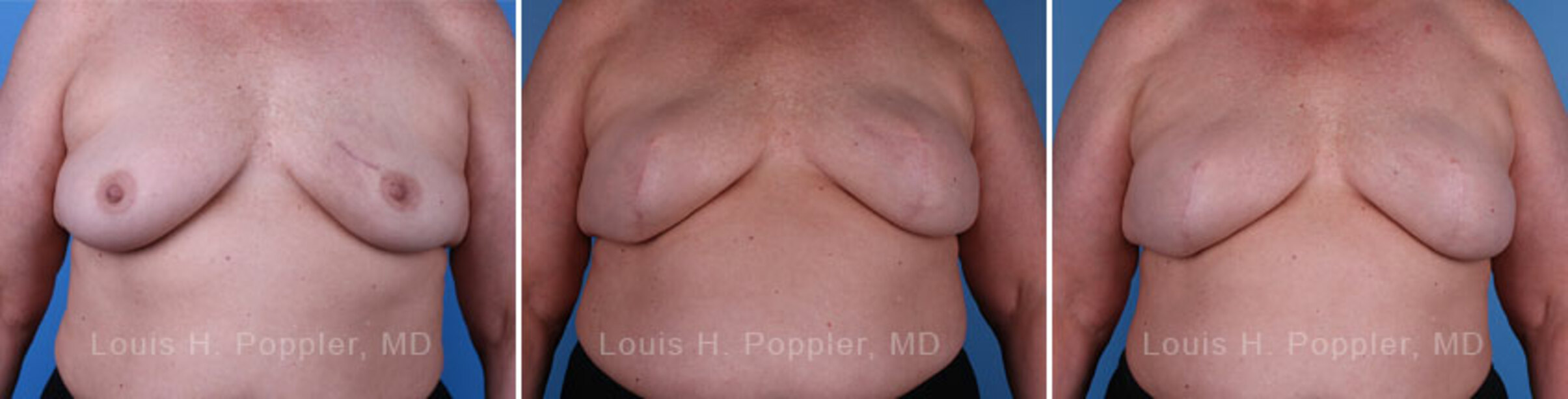Breast reconstruction surgery before and after photos
