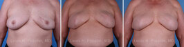 Breast reconstruction surgery before and after photos