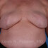 Breast reconstruction surgery before and after photos