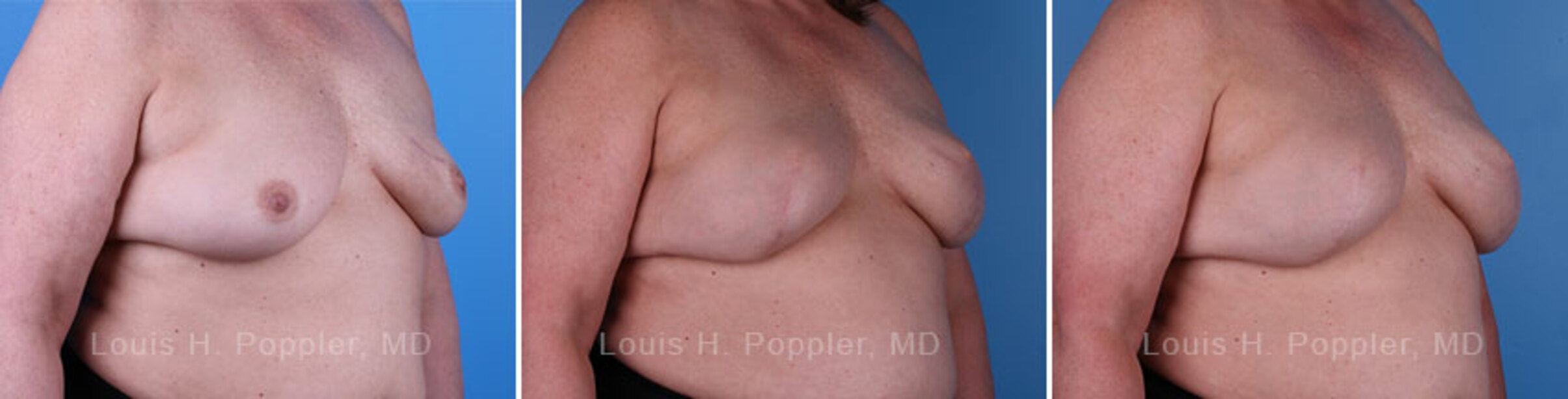 Breast reconstruction surgery before and after photos, right 45-degree angle view