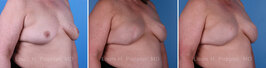 Breast reconstruction surgery before and after photos, right 45-degree angle view