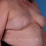 Breast reconstruction surgery before and after photos, right 45-degree angle view