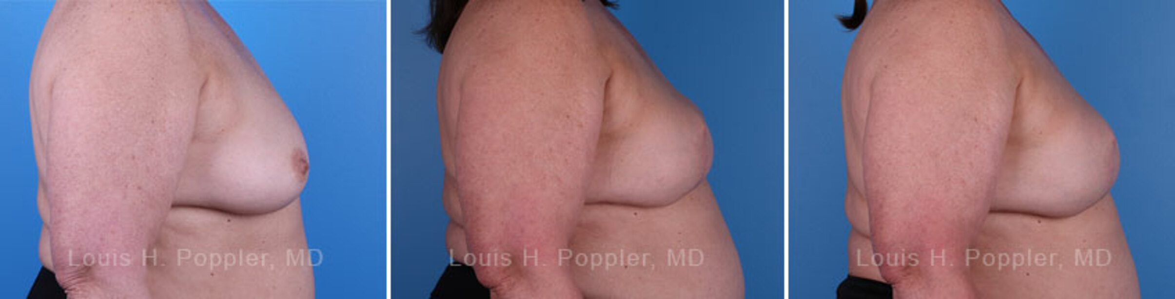 Breast reconstruction surgery before and after photos, right 90-degree angle view
