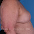 Breast reconstruction surgery before and after photos, right 90-degree angle view