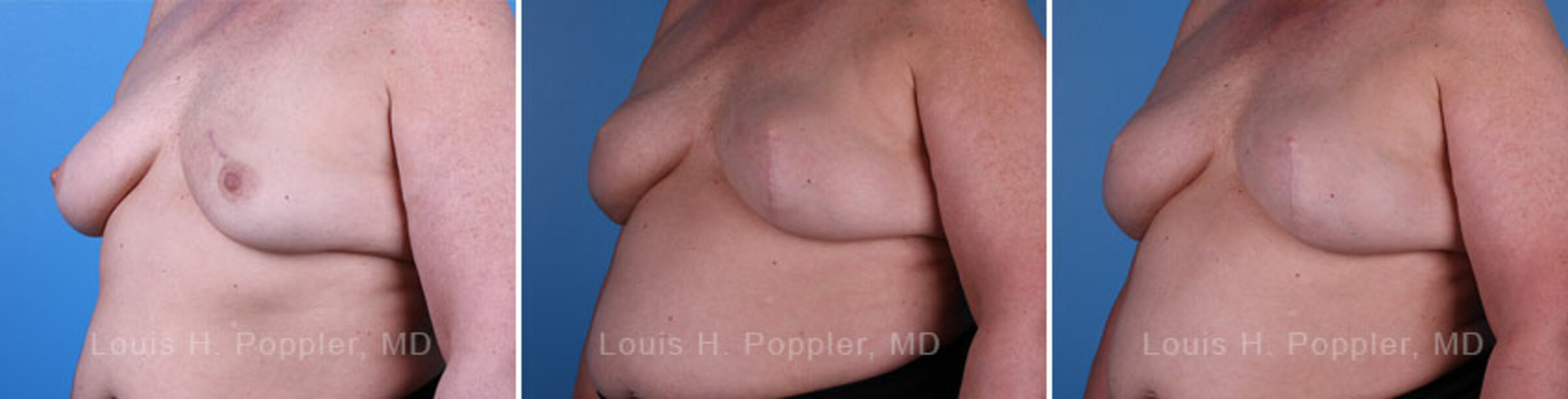 Breast reconstruction surgery before and after photos, left 45-degree angle view