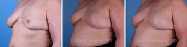 Breast reconstruction surgery before and after photos, left 45-degree angle view
