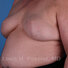 Breast reconstruction surgery before and after photos, left 45-degree angle view