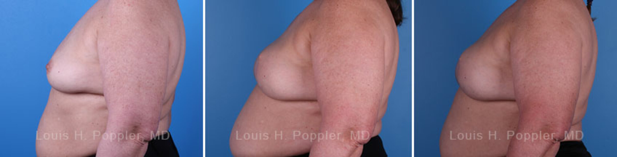 Breast reconstruction surgery before and after photos, left 90-degree angle view