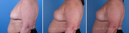 Breast reconstruction surgery before and after photos, left 90-degree angle view